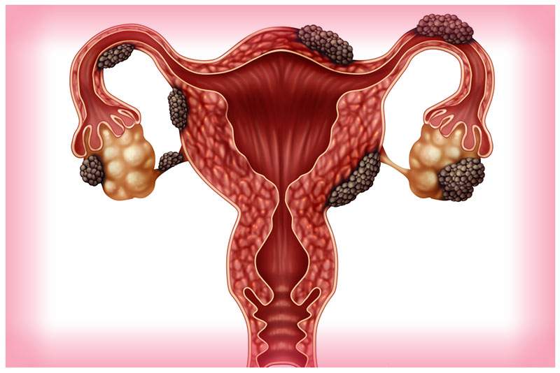 De ce Endometrioza provoacă creșterea în greutate și cum pot să o opresc?
