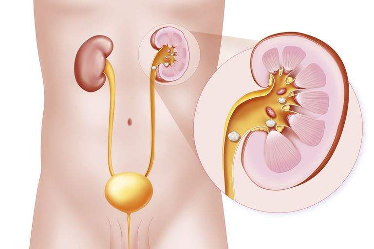 nisip la rinichi simptome forum remedii de încredere pentru prostatită
