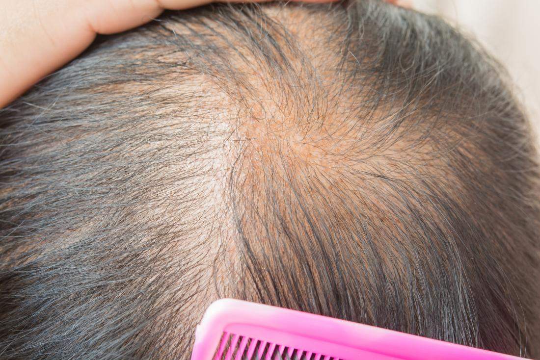 Pierderea părului axilar | ROmedic