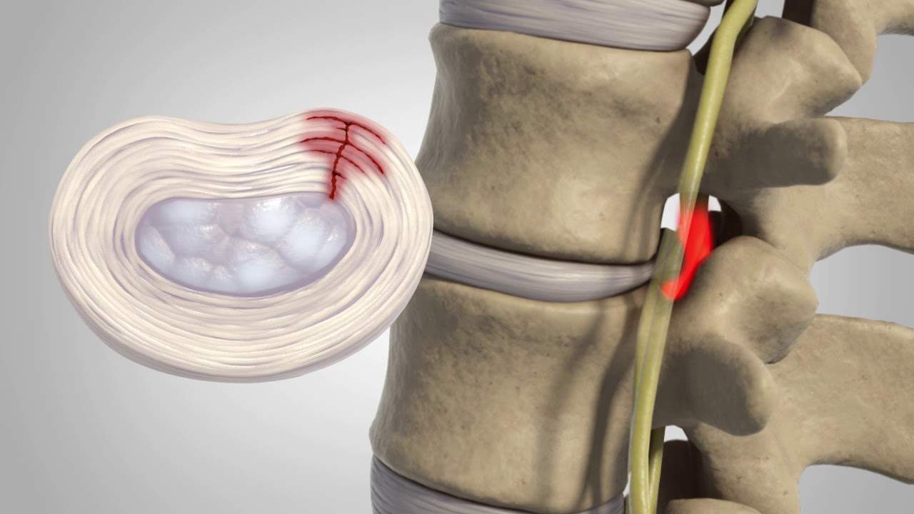 tratamentul medical al coloanei vertebrale sacrale