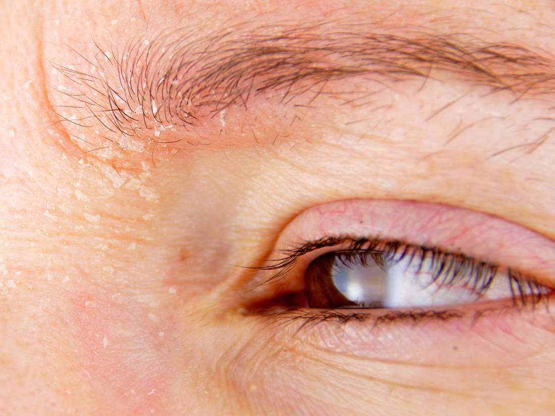 Cum tratăm alergiile oculare de primăvară: remediile simptomelor