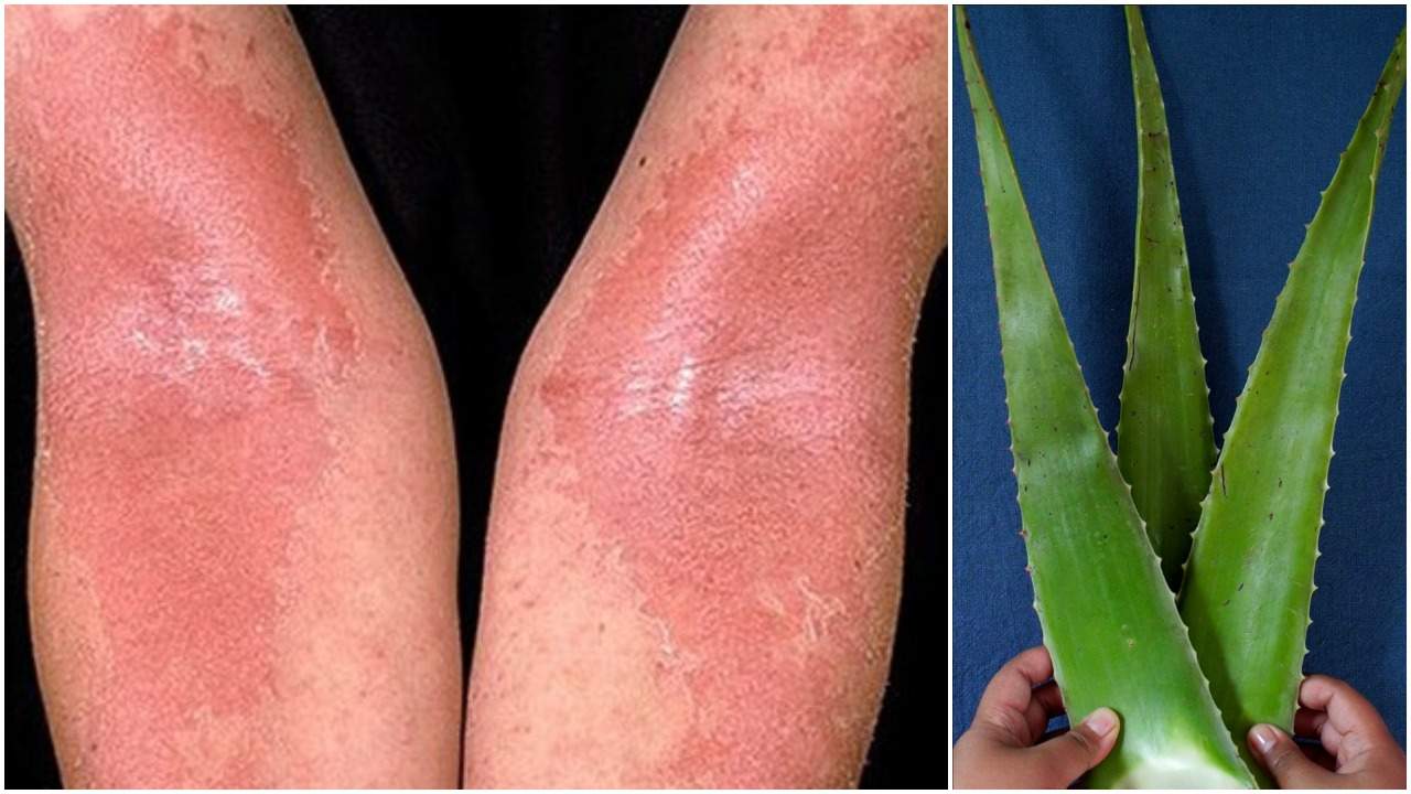 cea mai bună îngrijire anti-îmbătrânire a pielii pentru eczeme