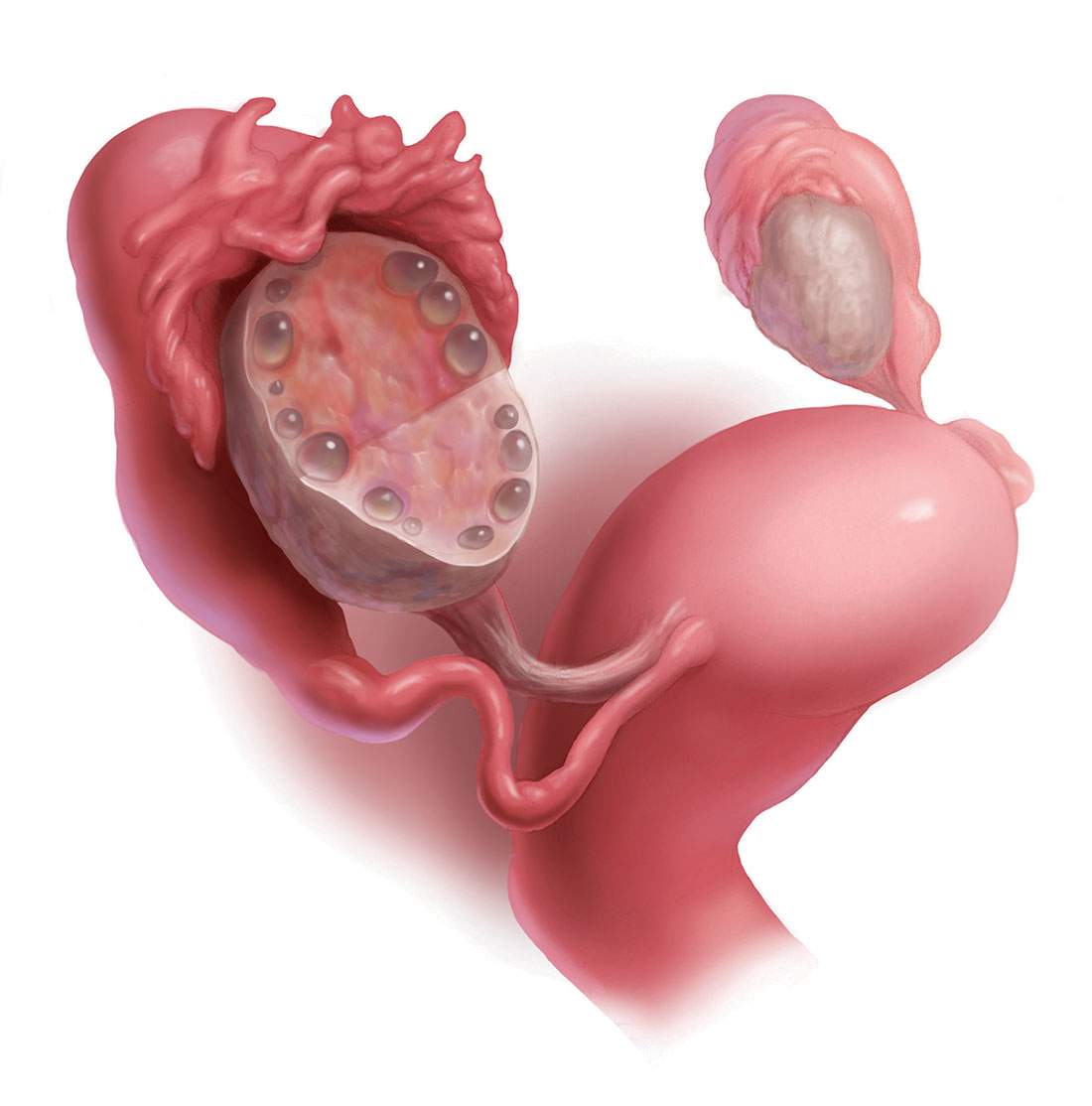 Tot ce trebuie sa stii despre ovare polichistice, diagnostic si tratament