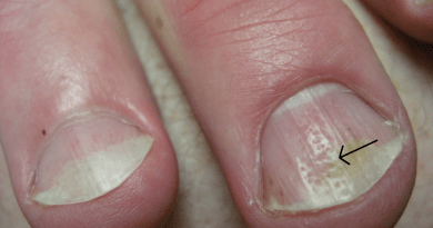 11 avertismente de sanatate vizibile pe unghiile tale